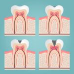 stages of decay, early cavities