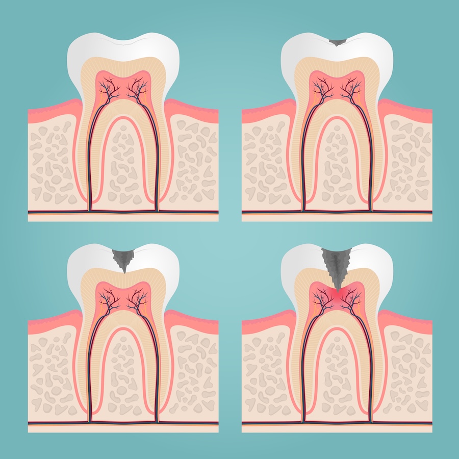 stages of decay, early cavities