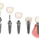 dental implant consultation, parts of a dental implant, second opinion
