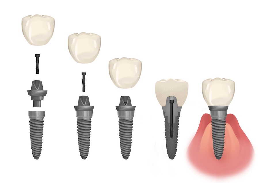 dental implant consultation, parts of a dental implant, second opinion